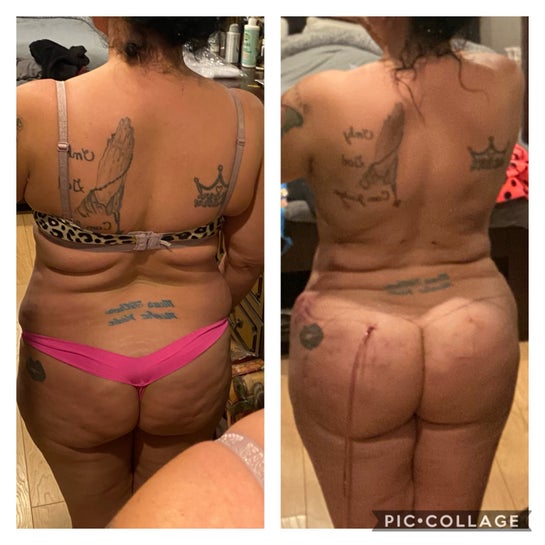 BBL Brazilian Butt Lift - What I wish I knew before my Lipo360 BBL Fat  Transfer J-plasma and Inner thigh procedure: Your survival guide to surgery  and all my lessons learned: Booty