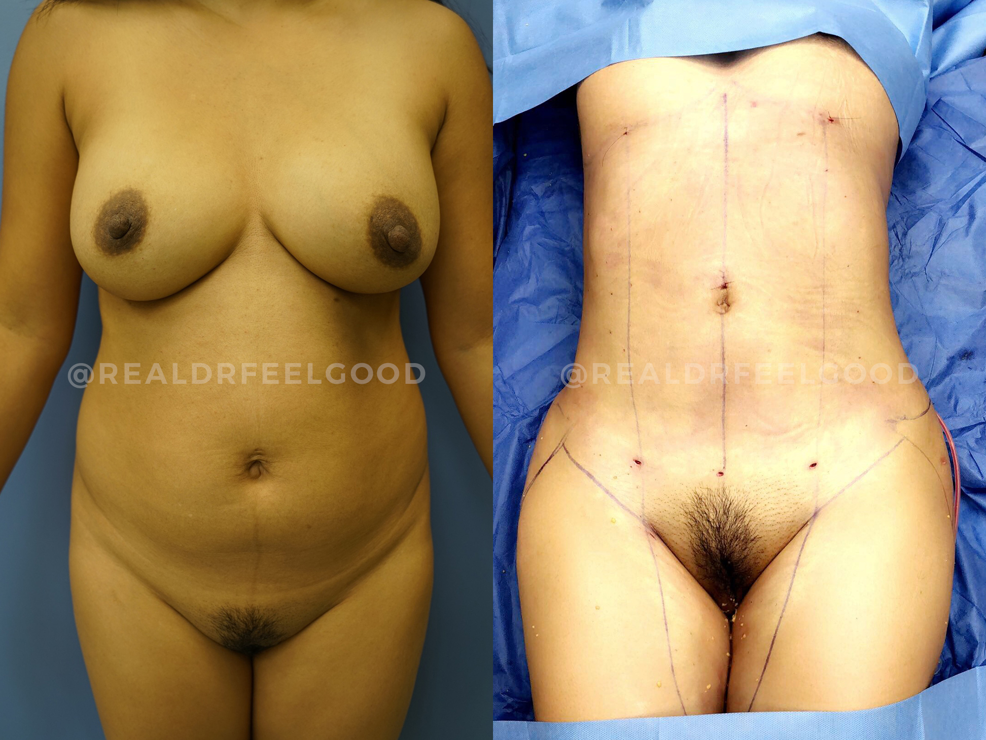 BBL (Brazilian Butt Lift) Before and After Photo. Surgery performed by Dr. Mark X. Lowney in Boston, MA.