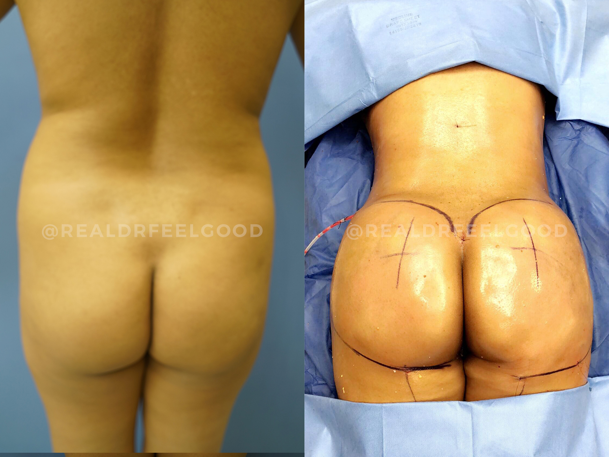 BBL (Brazilian Butt Lift) Before and After Photo. Surgery performed by Dr. Mark X. Lowney in Boston, MA.