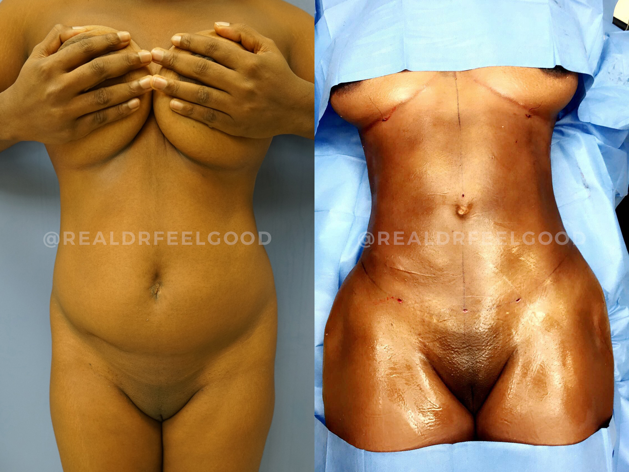BBL (Brazilian Butt Lift) Before and After Photo. Surgery performed by Dr. Mark X. Lowney in Boston, MA.