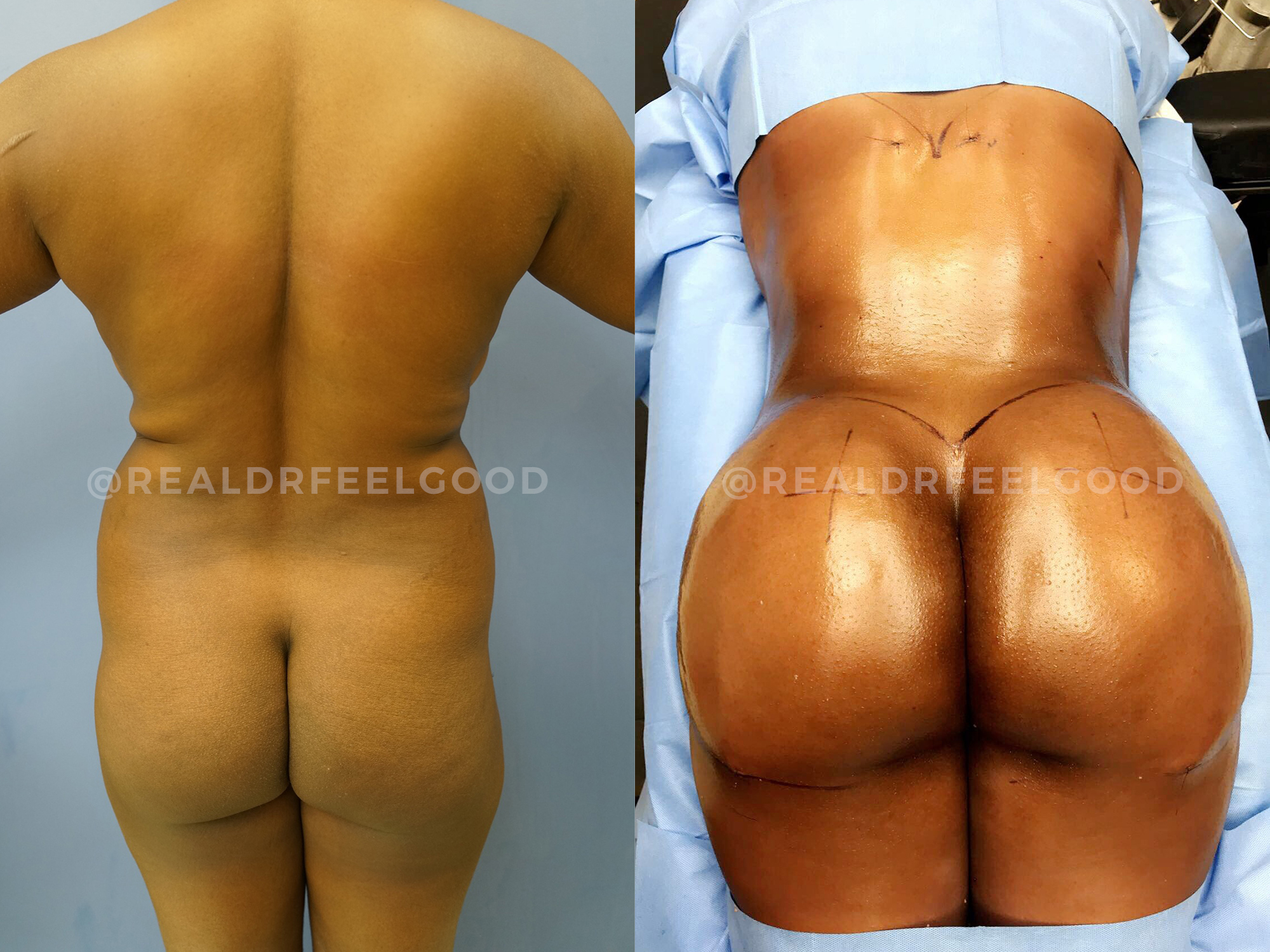 BBL (Brazilian Butt Lift) Before and After Photo. Surgery performed by Dr. Mark X. Lowney in Boston, MA.