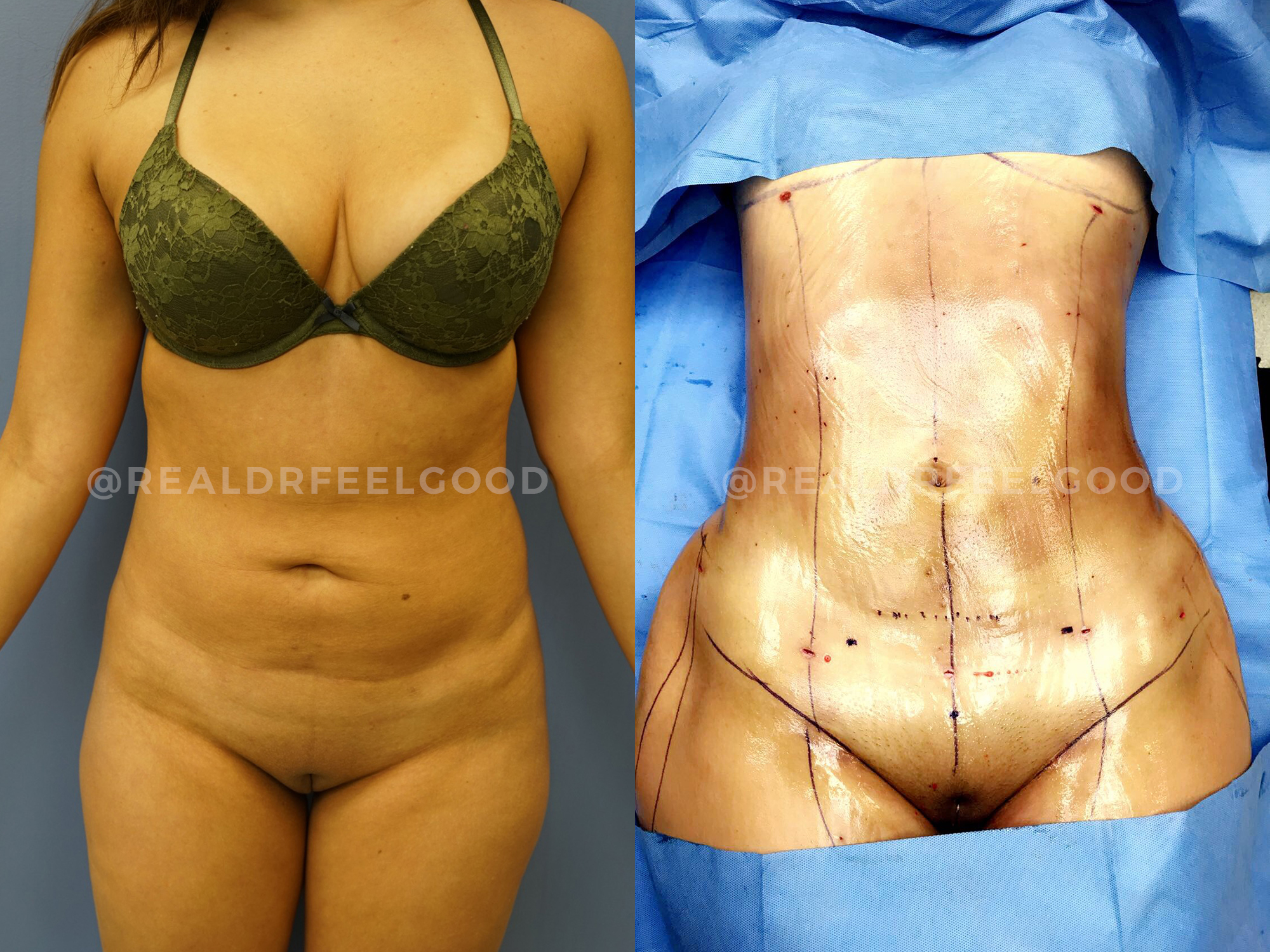 BBL (Brazilian Butt Lift) Before and After Photo. Surgery performed by Dr. Mark X. Lowney in Boston, MA.