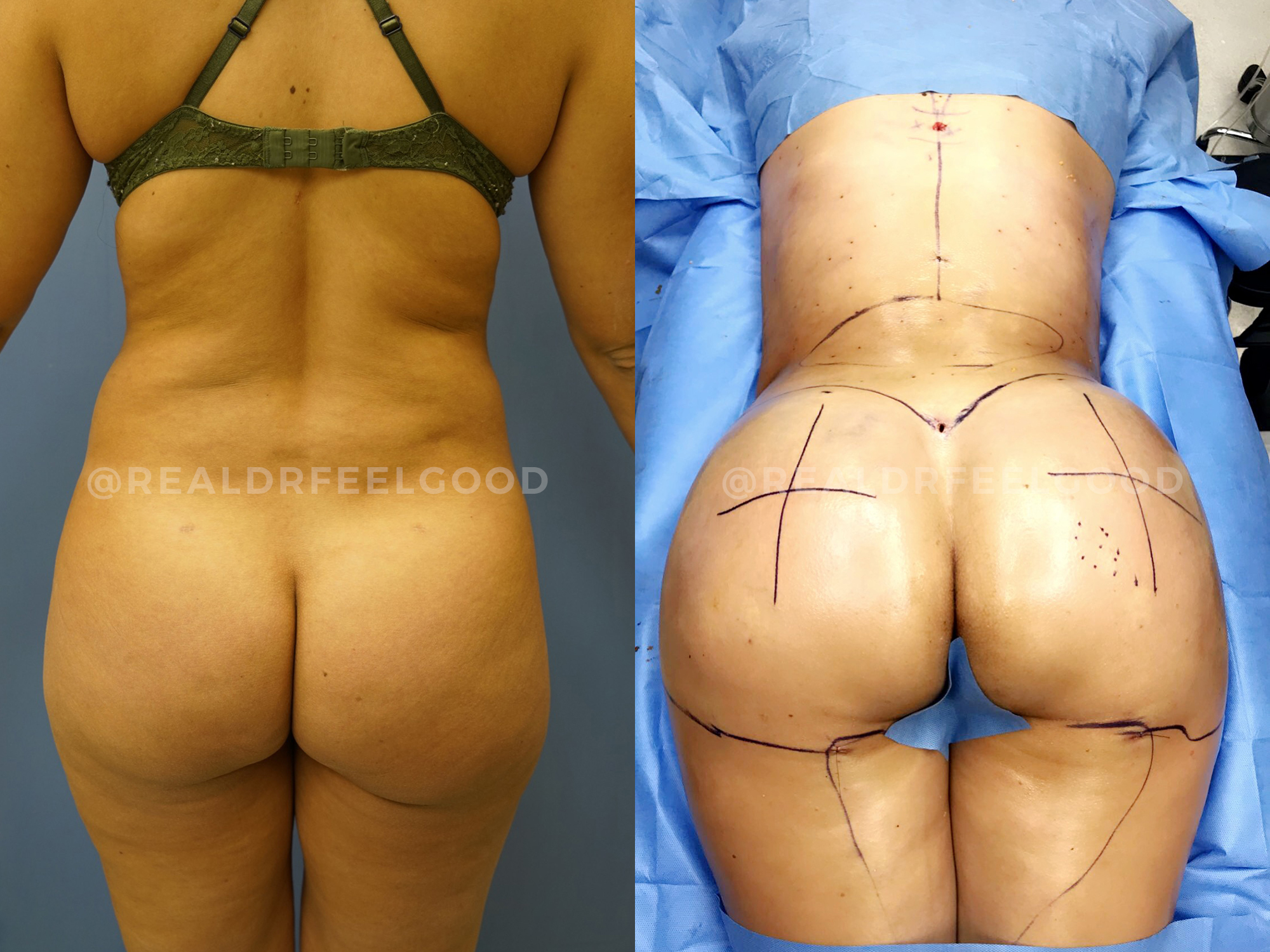 BBL (Brazilian Butt Lift) Before and After Photo. Surgery performed by Dr. Mark X. Lowney in Boston, MA.