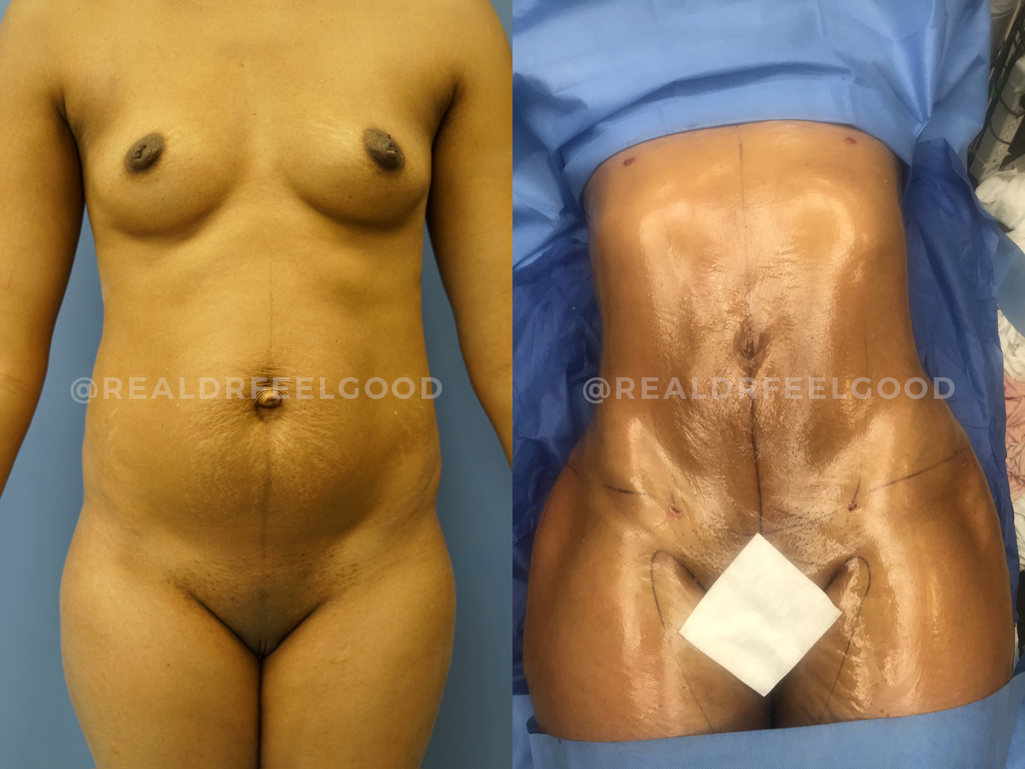 BBL (Brazilian Butt Lift) Before and After Photo. Surgery performed by Dr. Mark X. Lowney in Boston, MA.