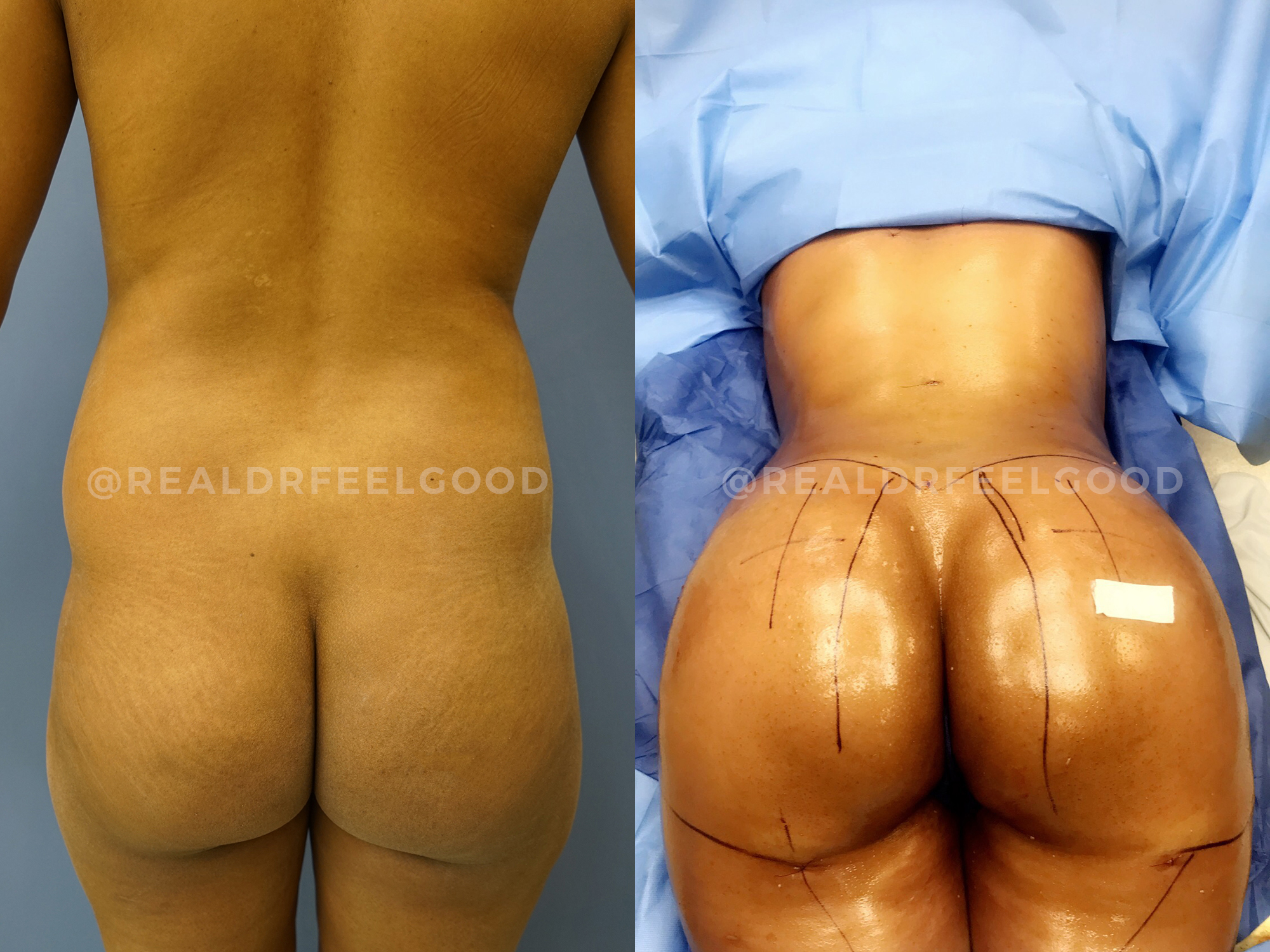 BBL (Brazilian Butt Lift) Before and After Photo. Surgery performed by Dr. Mark X. Lowney in Boston, MA.