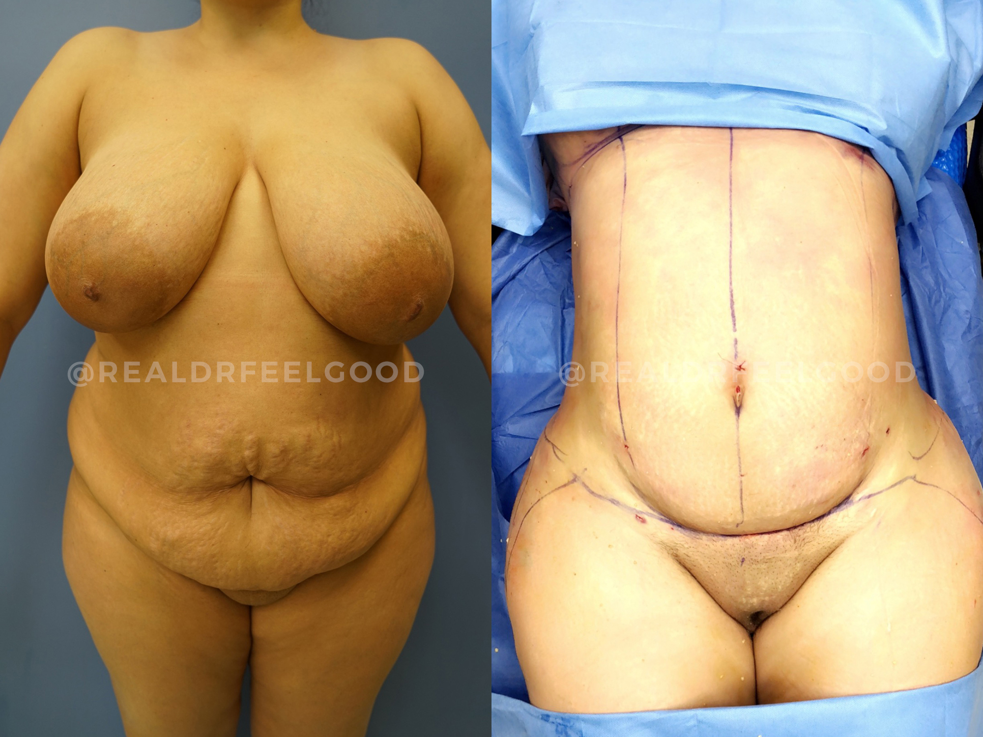 BBL (Brazilian Butt Lift) Before and After Photo. Surgery performed by Dr. Mark X. Lowney in Boston, MA.