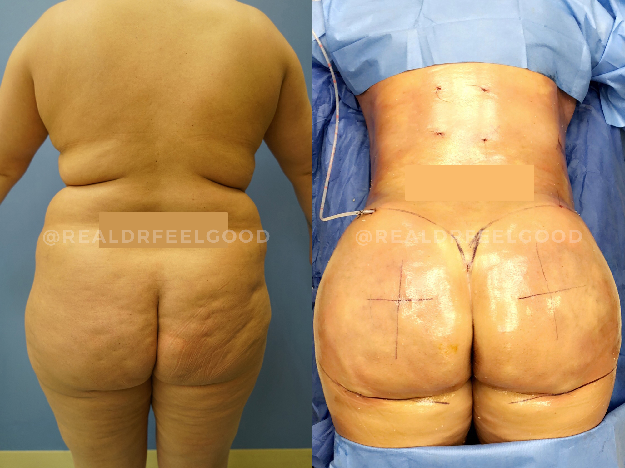 BBL (Brazilian Butt Lift) Before and After Photo. Surgery performed by Dr. Mark X. Lowney in Boston, MA.