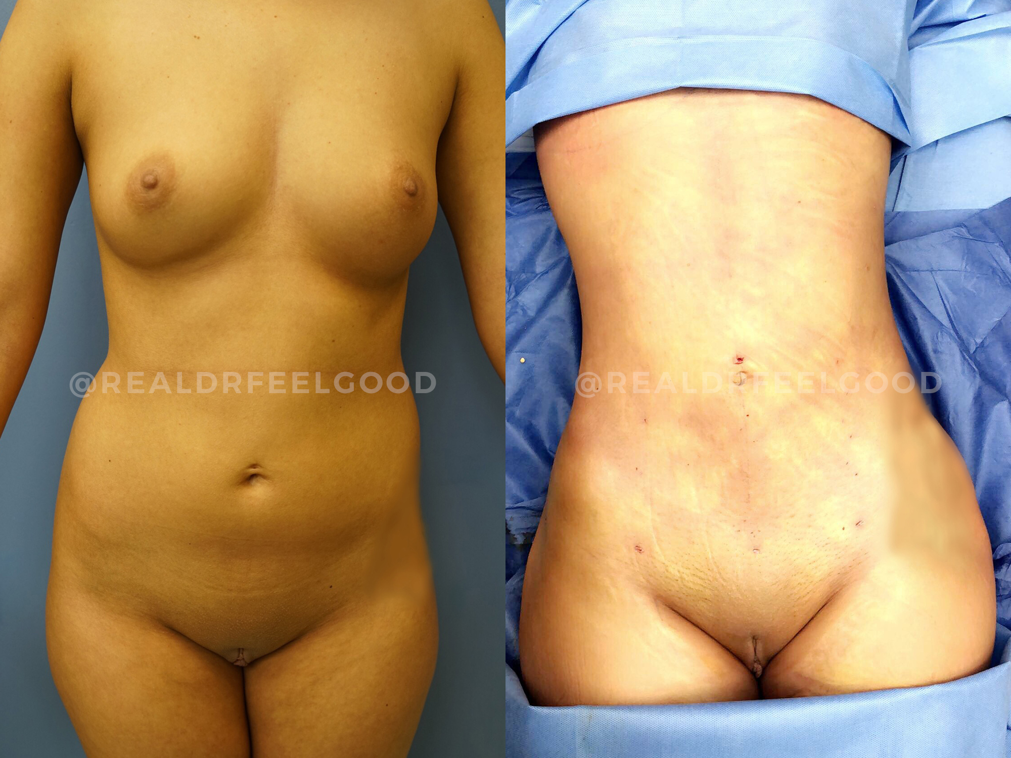 BBL (Brazilian Butt Lift) Before and After Photo. Surgery performed by Dr. Mark X. Lowney in Boston, MA.
