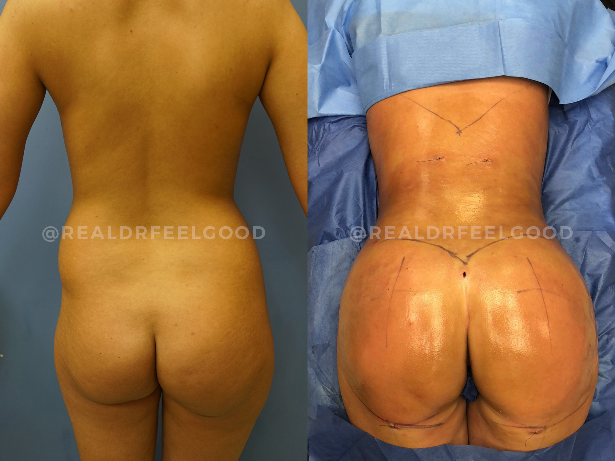 BBL (Brazilian Butt Lift) Before and After Photo. Surgery performed by Dr. Mark X. Lowney in Boston, MA.