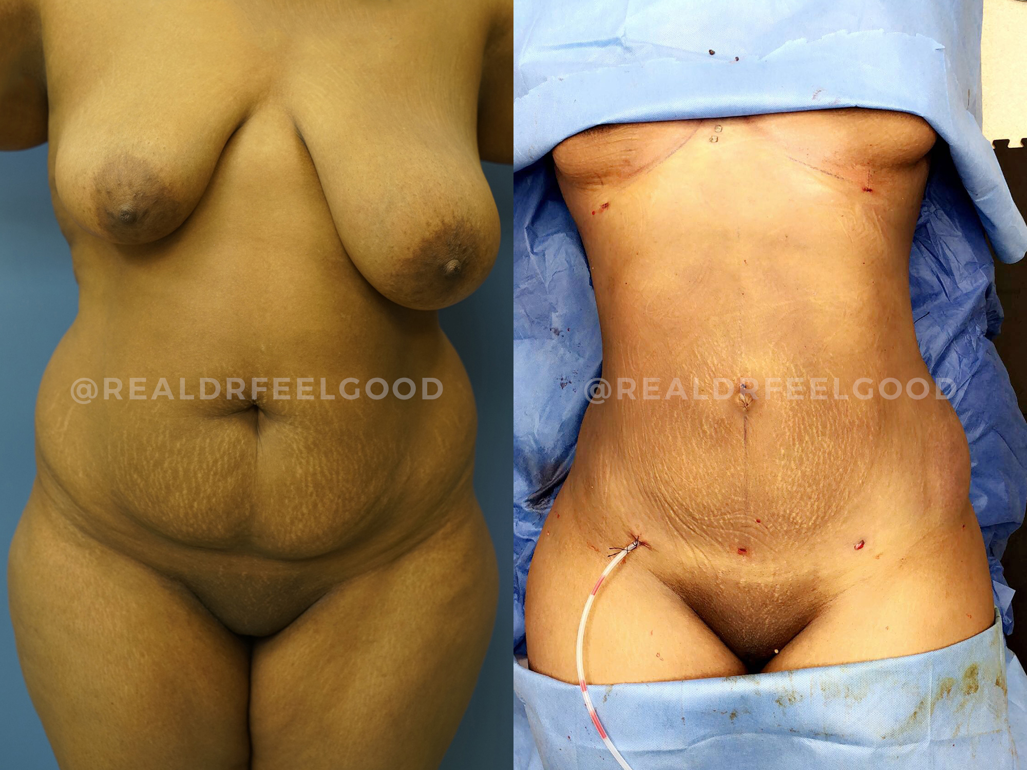 BBL (Brazilian Butt Lift) Before and After Photo. Surgery performed by Dr. Mark X. Lowney in Boston, MA.