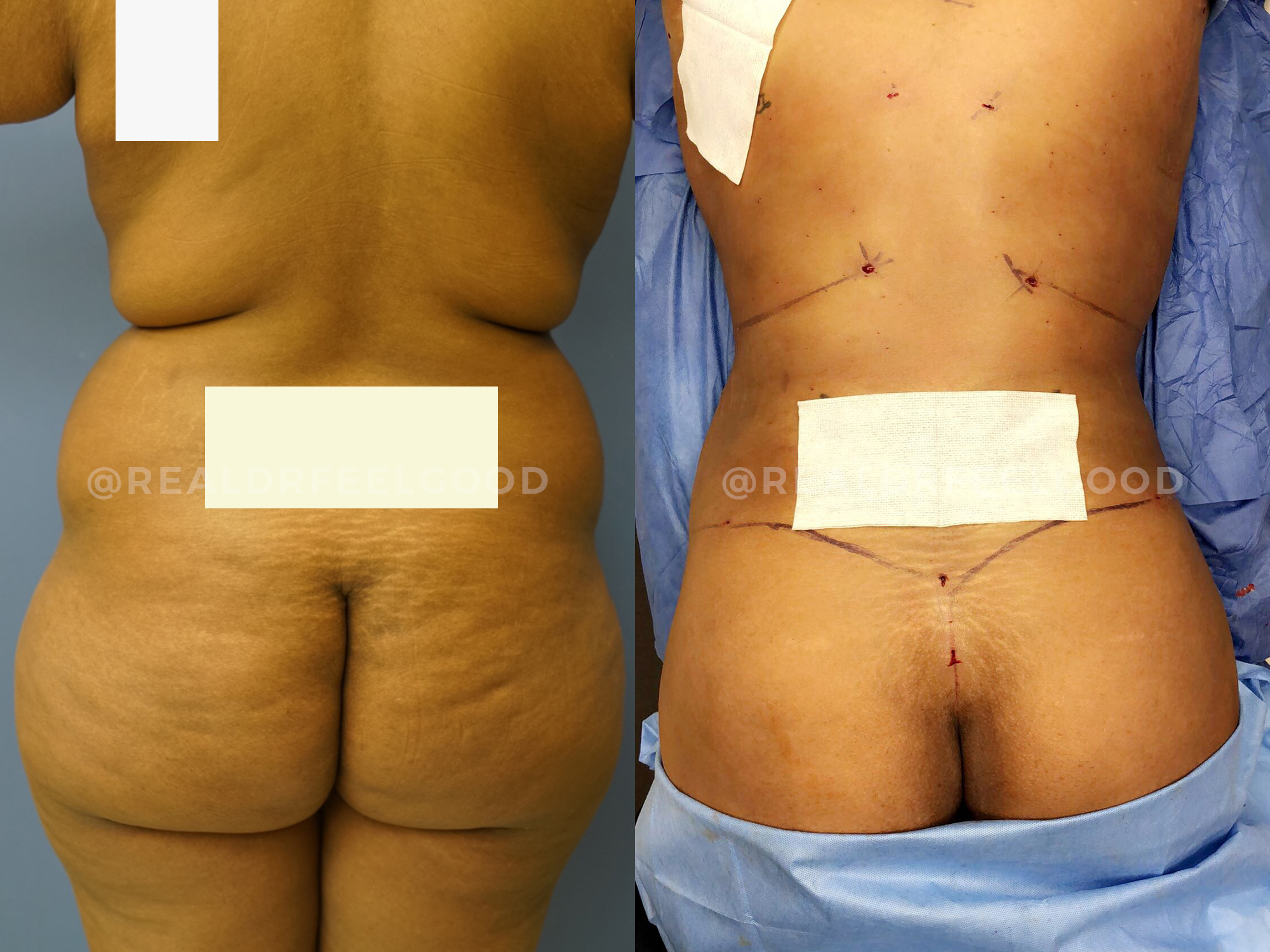 BBL (Brazilian Butt Lift) Before and After Photo. Surgery performed by Dr. Mark X. Lowney in Boston, MA.