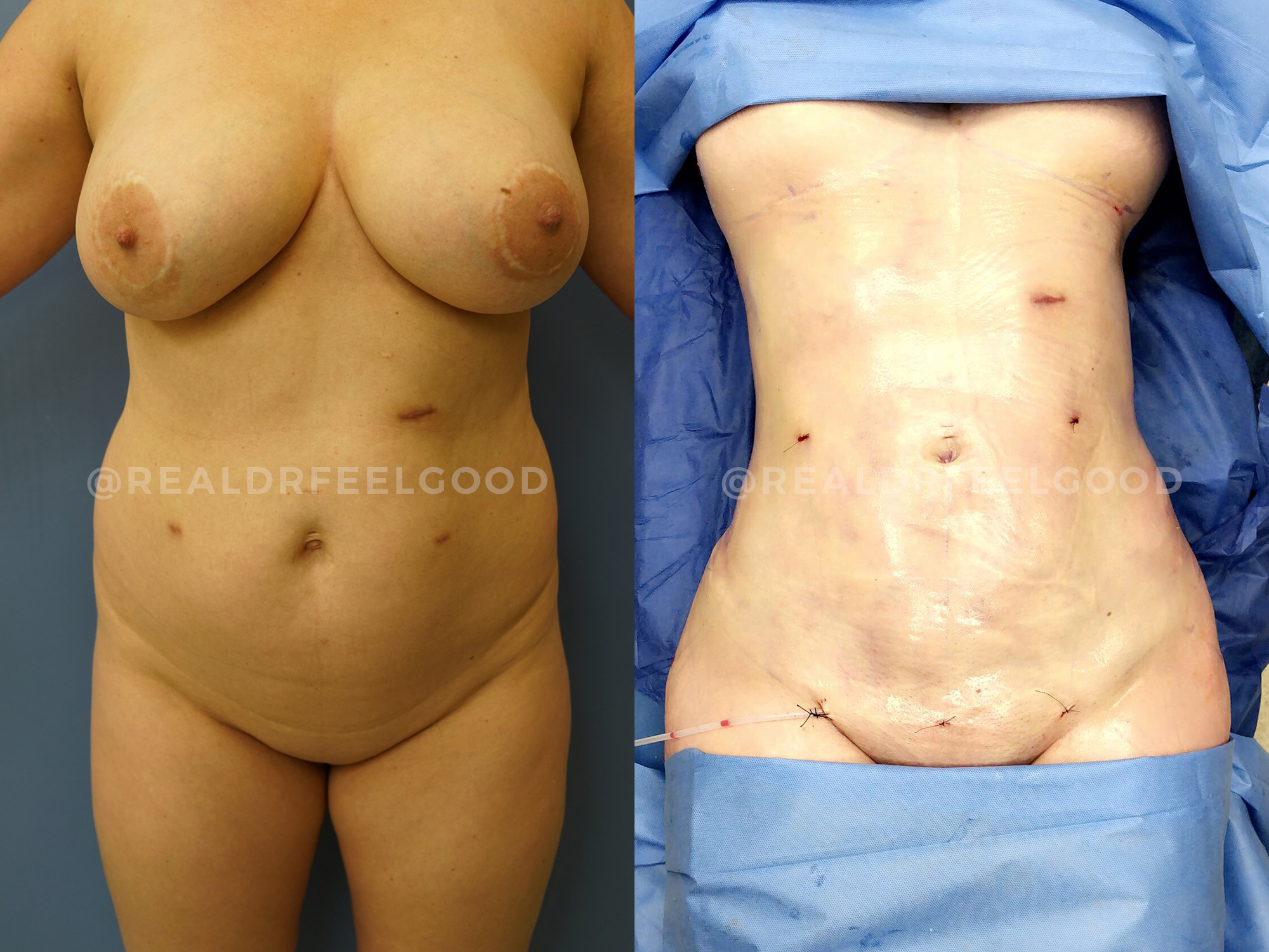 BBL (Brazilian Butt Lift) Before and After Photo. Surgery performed by Dr. Mark X. Lowney in Boston, MA.