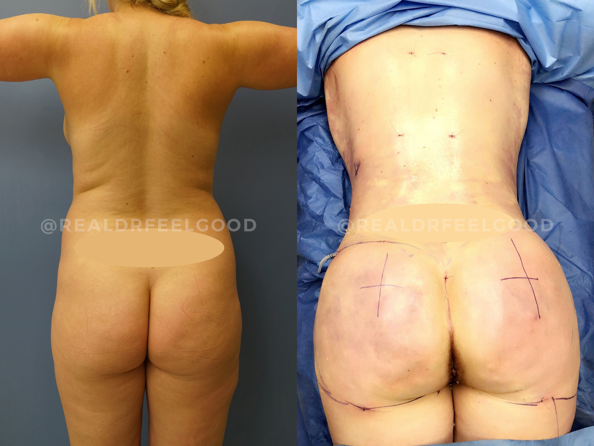 BBL (Brazilian Butt Lift) Before and After Photo. Surgery performed by Dr. Mark X. Lowney in Boston, MA.