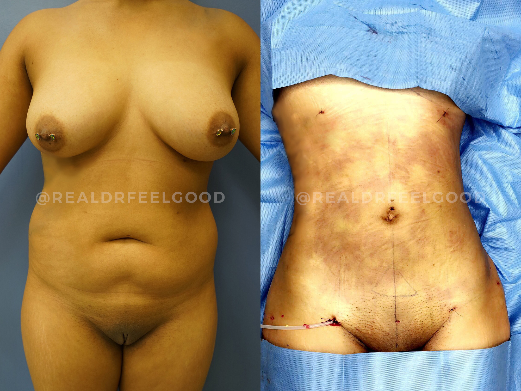 BBL (Brazilian Butt Lift) Before and After Photo. Surgery performed by Dr. Mark X. Lowney in Boston, MA.