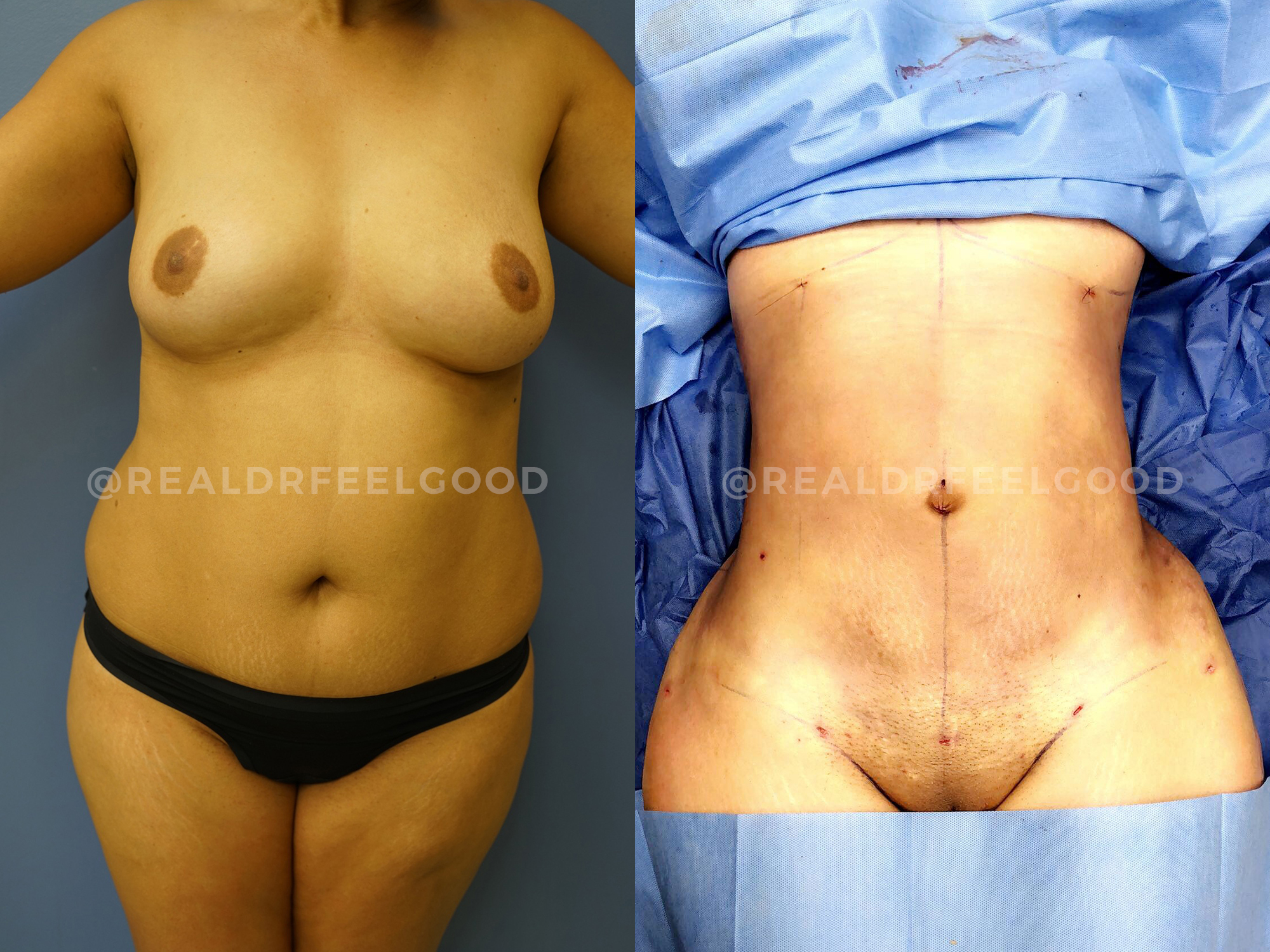 BBL (Brazilian Butt Lift) Before and After Photo. Surgery performed by Dr. Mark X. Lowney in Boston, MA.