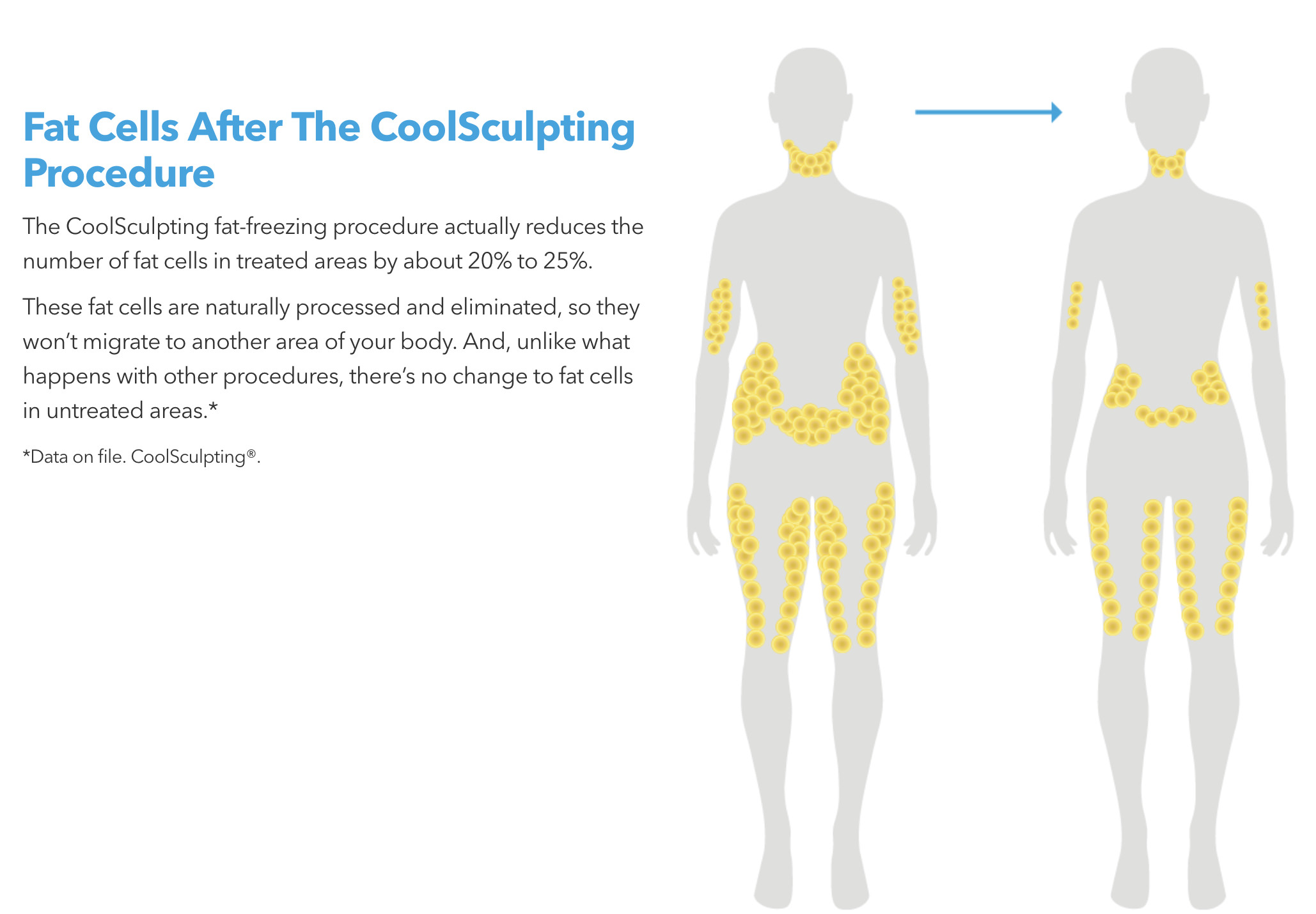 CoolSculpting