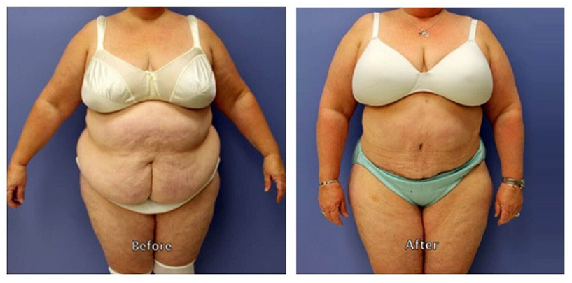 tummy-tuck-procedure-advanced-body-sculpting-massachusetts-cosmetic-2