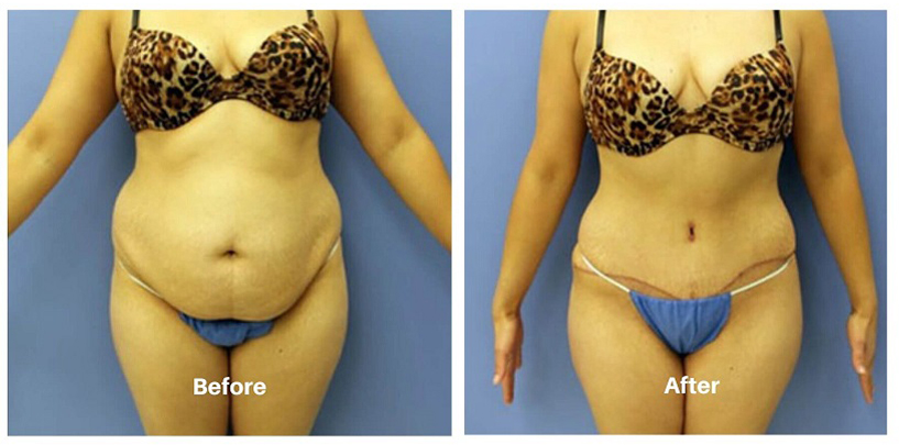 tummy-tuck-procedure-advanced-body-sculpting-massachusetts-cosmetic-4