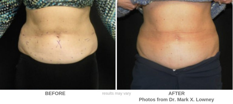 CoolSculpting Before and After by Body Part