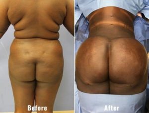 BBL-before-and-after-real-patient-results-1-2