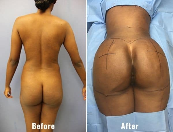 BBL-before-and-after-real-patient-results-2-2