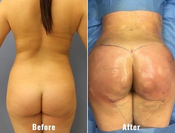 BBL-before-and-after-real-patient-results-3