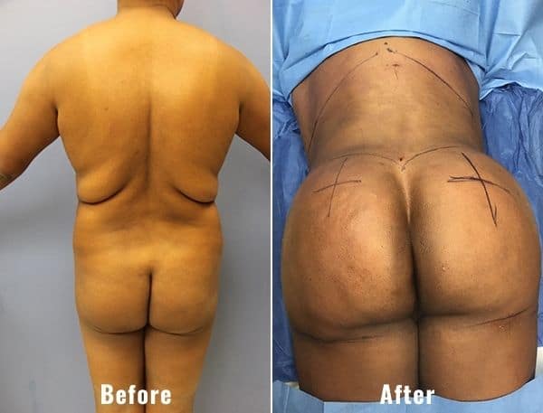 BBL-before-and-after-real-patient-results-4