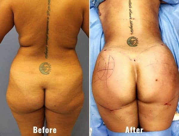 BBL-before-and-after-real-patient-results-5