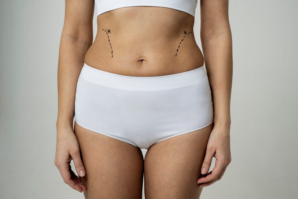DOES FAT REDISTRIBUTE AFTER LIPOSUCTION? - Advanced Body Sculpting