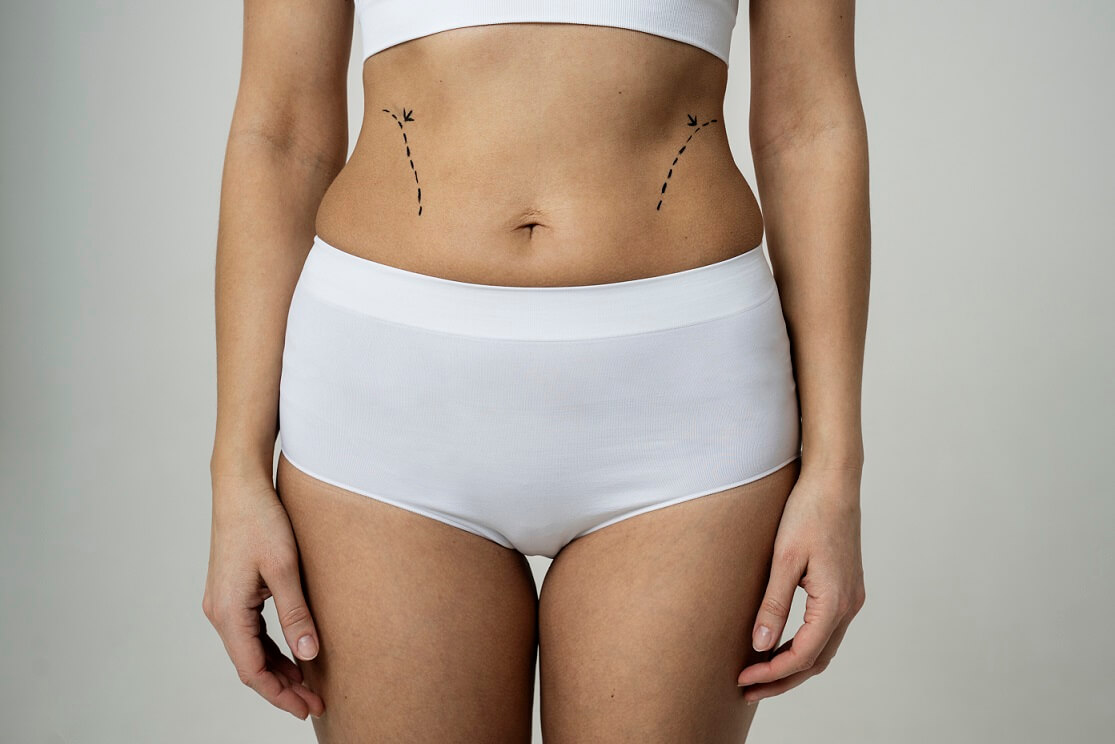 DOES FAT REDISTRIBUTE AFTER LIPOSUCTION? - Advanced Body Sculpting