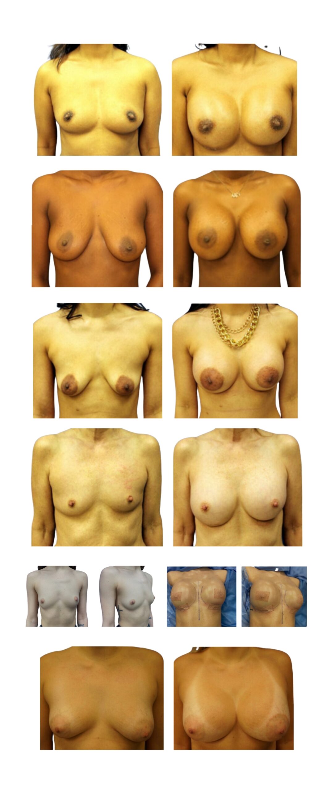 breast augmentation before and after photo