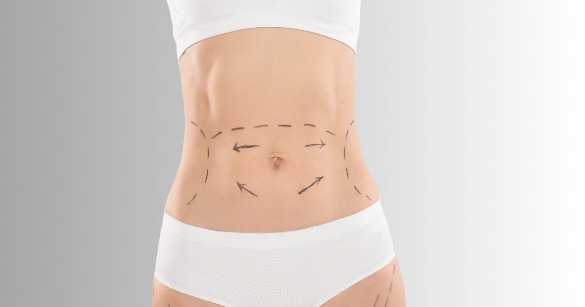 Tummy being marked for liposuction