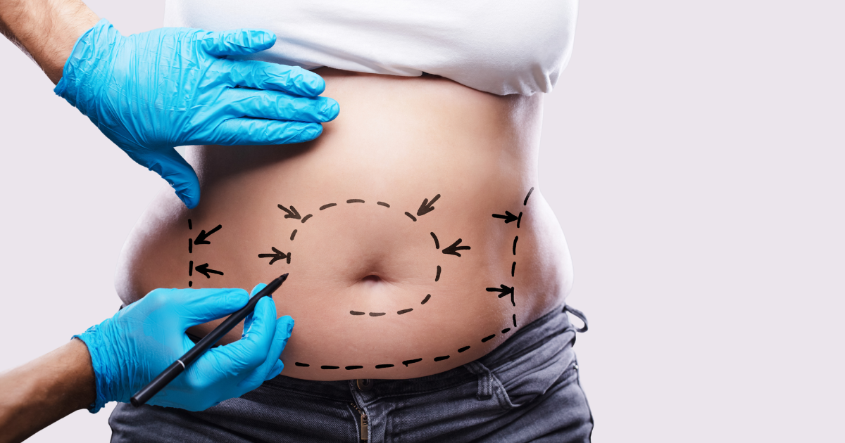 woman having liposuction on her stomach