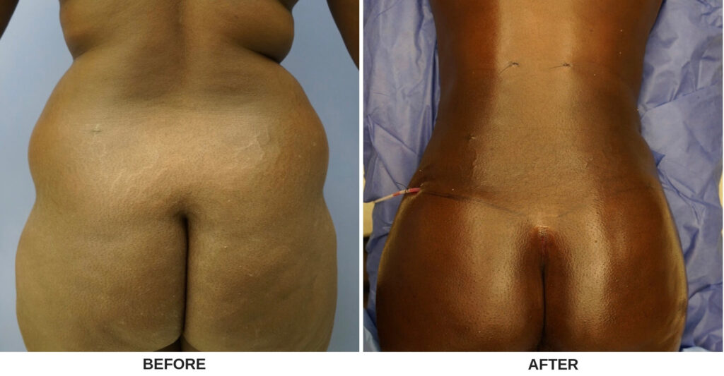Before and after photo of a woman's body after Liposuction treatments at Advanced Body Sculpting.