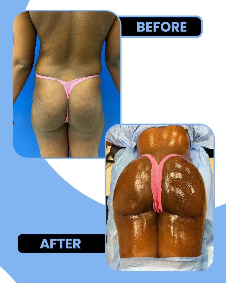 Brazilian Butt Lift before and after