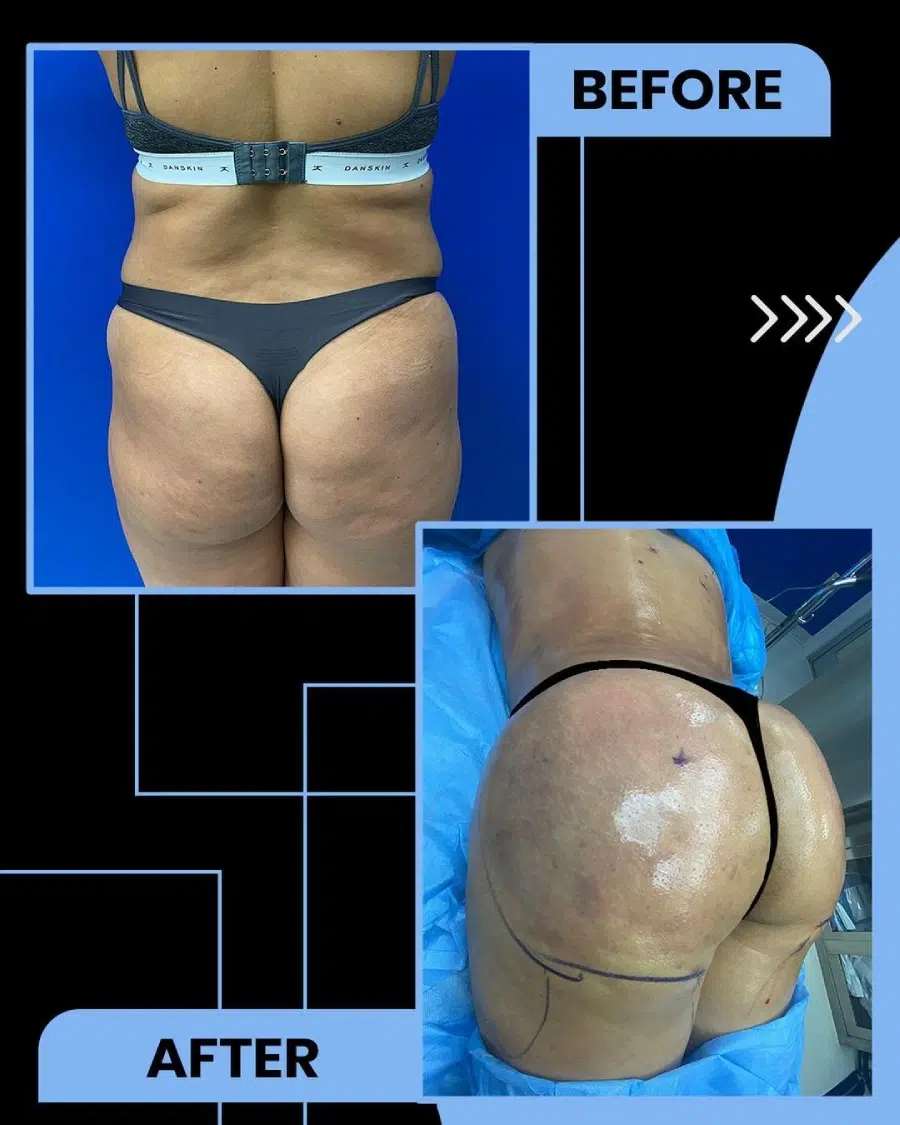 Brazilian Butt Lift before and after