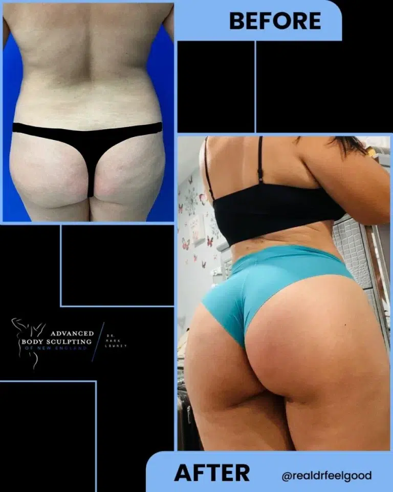 Brazilian Butt Lift before and after