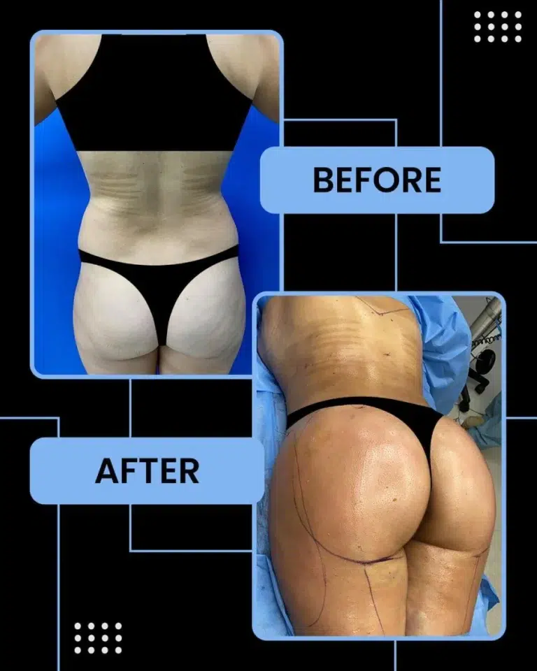 Brazilian Butt Lift before and after