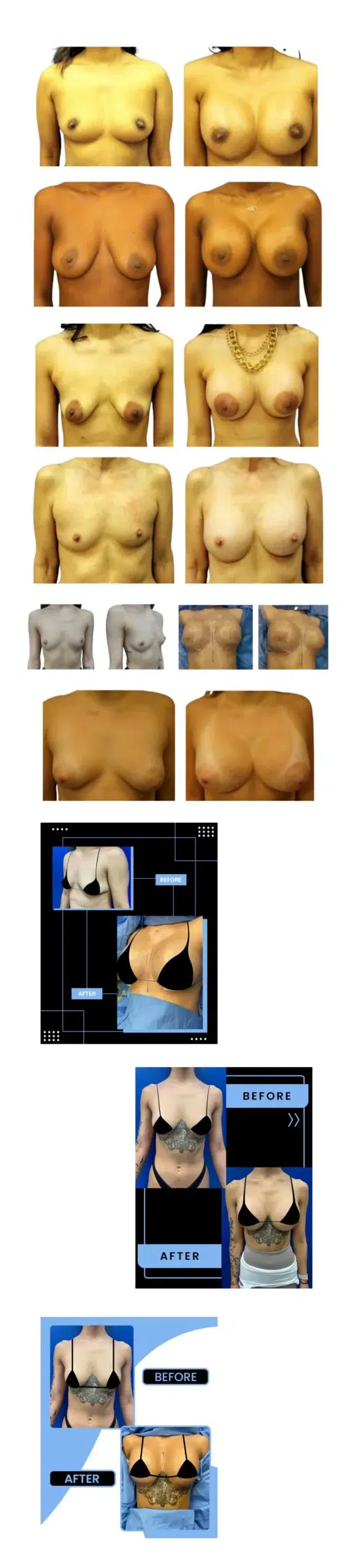 Breast Augmentation Before and After