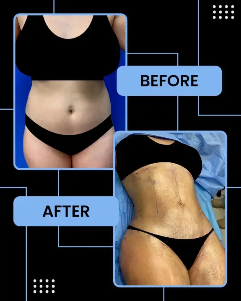 Liposuction Before and After