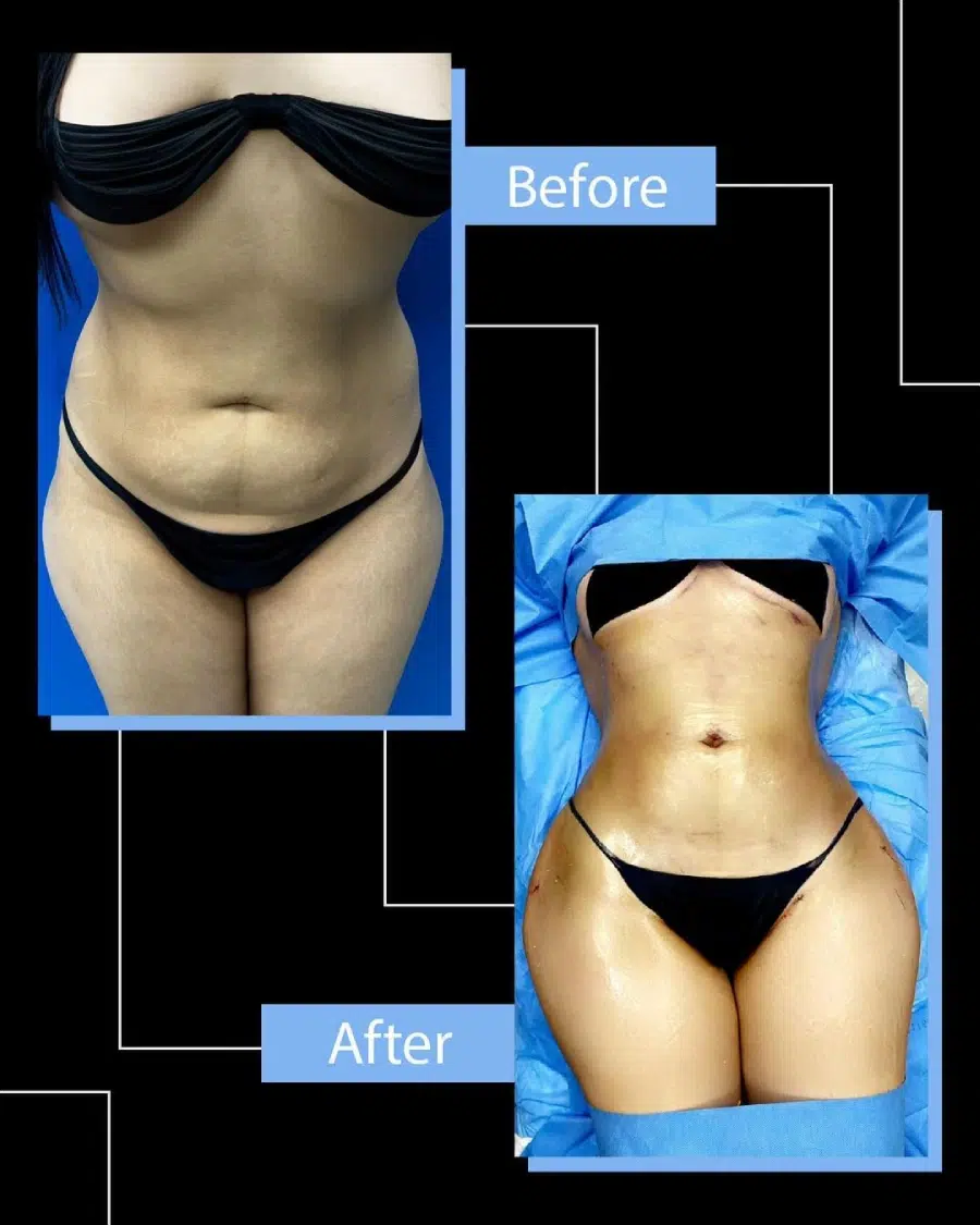 Liposuction Before and After