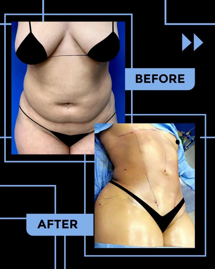 Liposuction Before and After