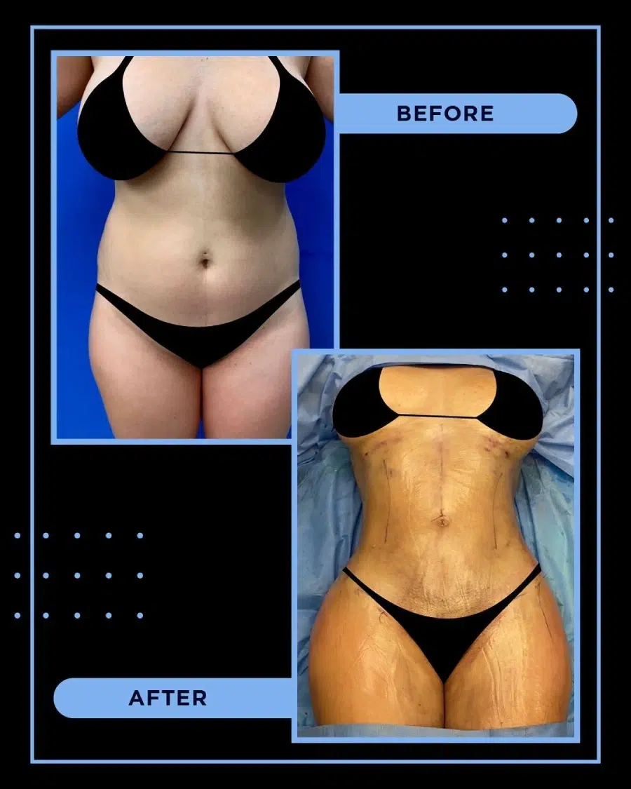 Liposuction Before and After