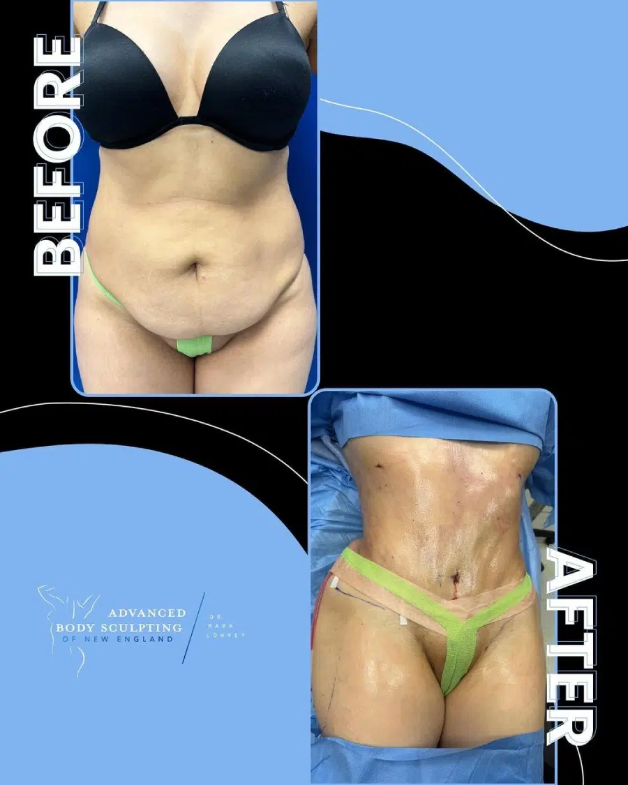 Tummy Tuck Before and After