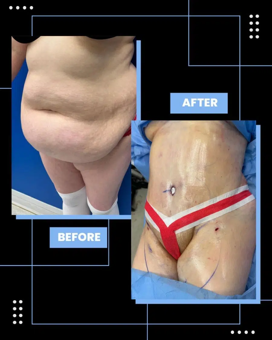 Tummy Tuck Before and After