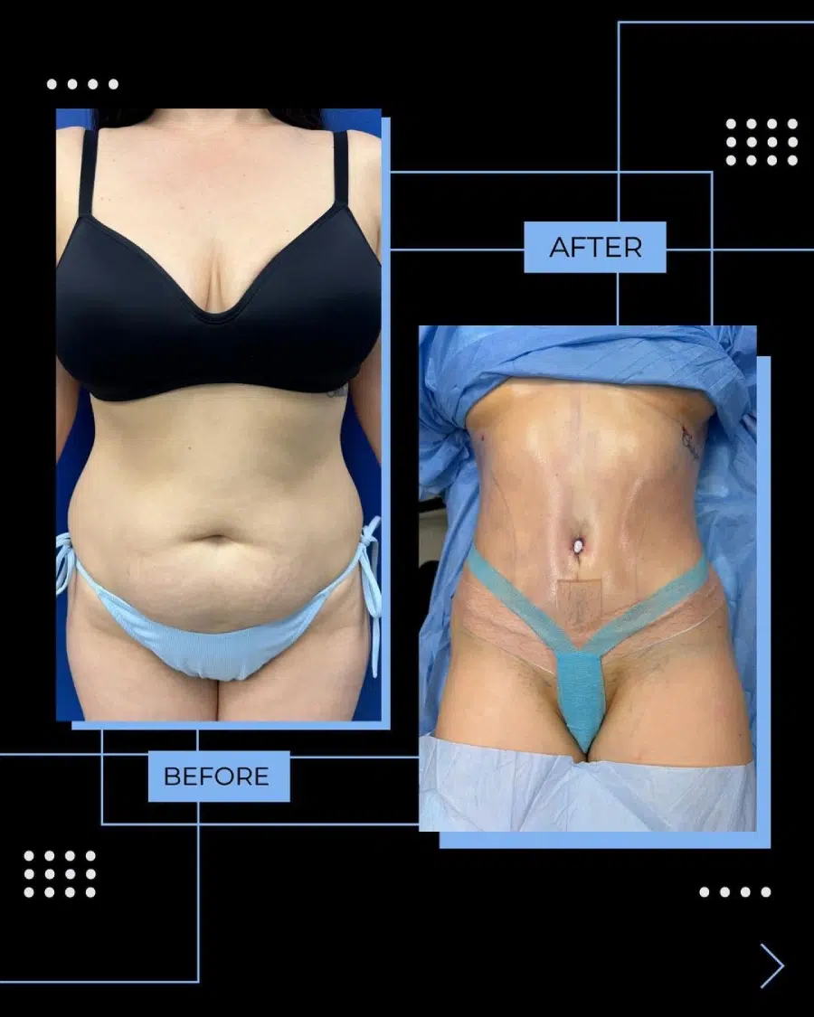 Tummy Tuck Before and After