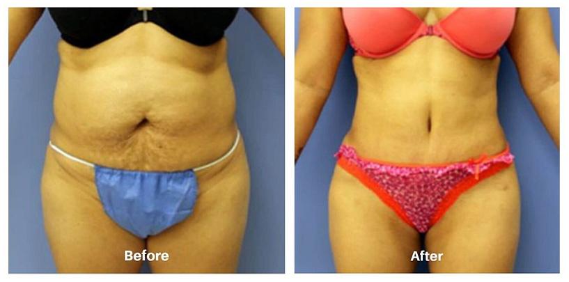 tummy-tuck-procedure-advanced-body-sculpting-massachusetts-cosmetic-3_11zon